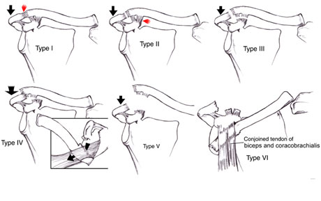 AC Joint Reconstruction Surgery